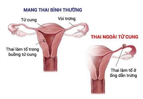 Dấu hiệu mang thai ngoài tử cung thường là: đau bụng dữ dội kèm theo tình trạng ra máu đen lợn cợn như bã cà phê, đi ngoài, buồn nôn, nôn