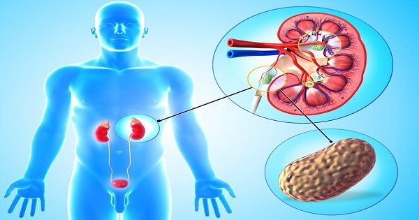 Sỏi thận cũng là nguyên nhân gây ra tình trạng đau bụng dưới ở cả nam và nữ