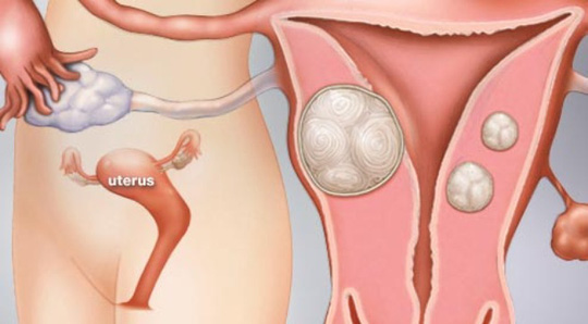 U xơ tử cung cũng là một trong những nguyên nhân gây đau sau khi quan hệ tình dục