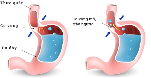 Đầy hơi, chướng bụng cũng là triệu chứng của bệnh trào ngược dạ dày, thực quản