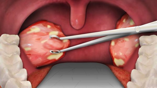 Viêm amidan hốc mủ cũng có thể làm nổi hạch cổ