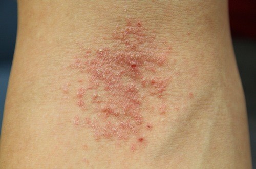Bệnh eczema cần được điều trị đúng cách