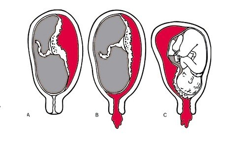 Nghiệm pháp bong rau, đỡ rau, kiểm tra bánh rau thường được nói đến trong các cuộc sinh đẻ.