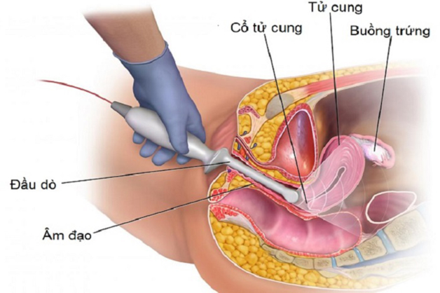 Siêu âm đầu dò là hình thức đưa đầu dò khoảng 2-3 inch vào trong ống âm đạo, dùng sóng âm tần cao, để hiển thị rõ hình ảnh tử cung, buồng trứng và một số bộ phận khác