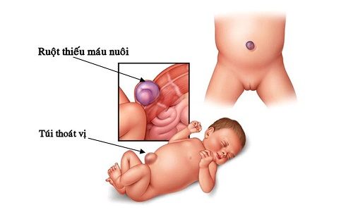 Thoát vị rốn là một dị tật khá phổ biến ở trẻ nhỏ.