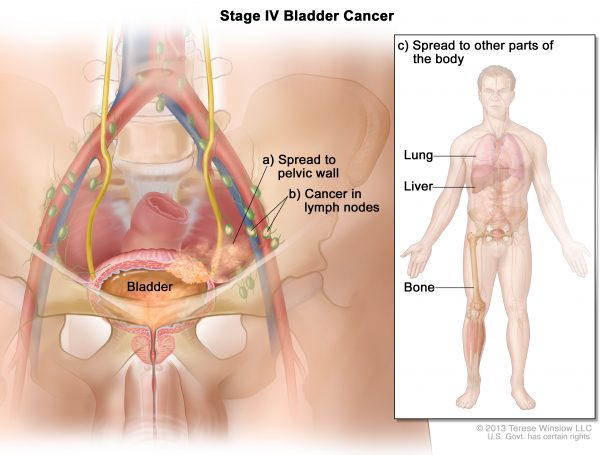 Ung thư bàng quang giai đoạn cuối không còn giới hạn ở bàng quang mà đã lan rộng đến các cơ quan ở xa như phổi, gan, xương...