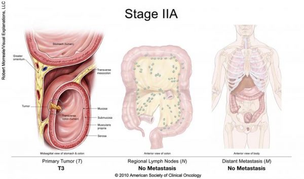 Ung thư đại tràng giai đoạn 2 (IIA)