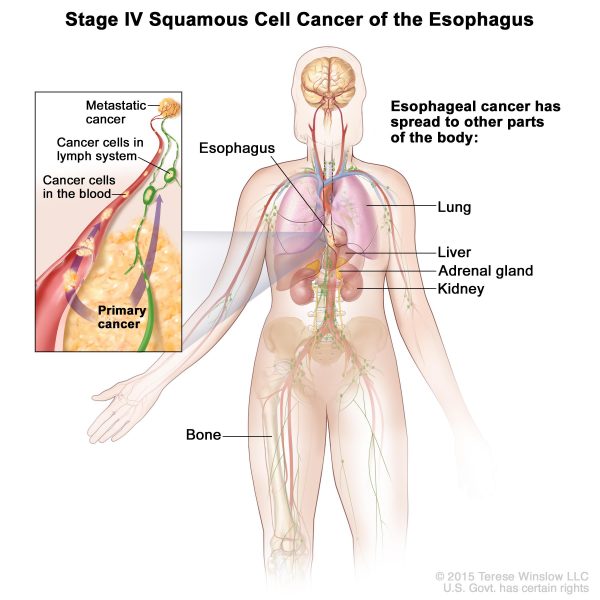 Ung thư thực quản giai đoạn cuối lan rộng đến các cơ quan ở xa như phổi, xương, tuyến thượng thận...