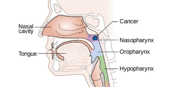 Có 4 triệu chứng ung thư vòm họng thường xuyên bị bỏ qua bởi các dấu hiệu này dễ gây nhầm lẫn với các bệnh lý vùng Tai – mũi –họng thông thường.