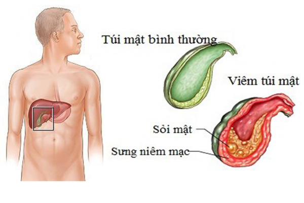 an gi sau mo soi mat 1