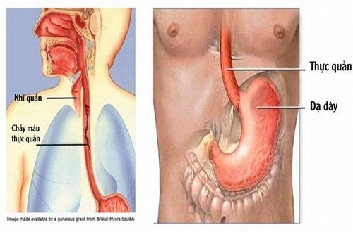 Giãn tĩnh mạch thực quản cần được phát hiên sớm và điều trị hiệu quả