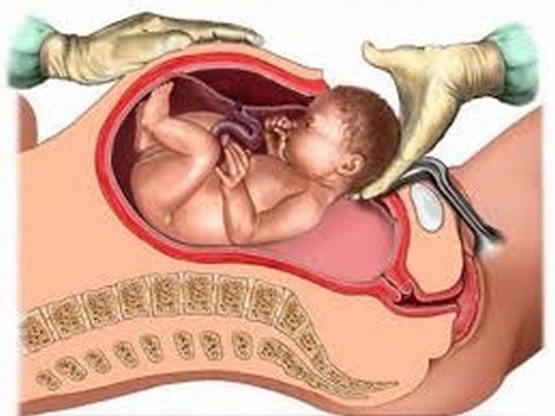 Phẫu thuật lấy thai nhằm lấy thai nhi ra khỏi tử cung người mẹ sau khi đã mở bụng và mở tử cung.