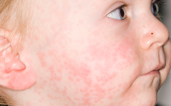 Nổi nốt đỏ, sốt có thể cảnh báo triệu chứng bệnh sởi