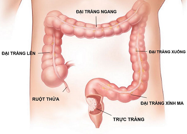 ung thư trực tràng có lây không
