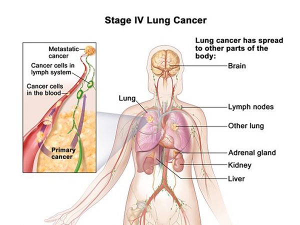Thông tin về ung thư phổi di căn lên não giai đoạn cuối