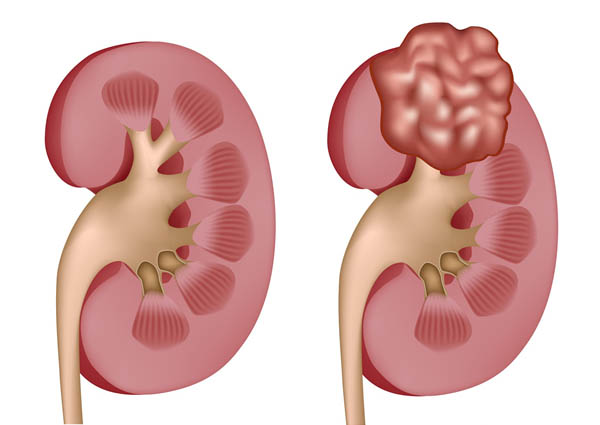 điều trị ung thư thận