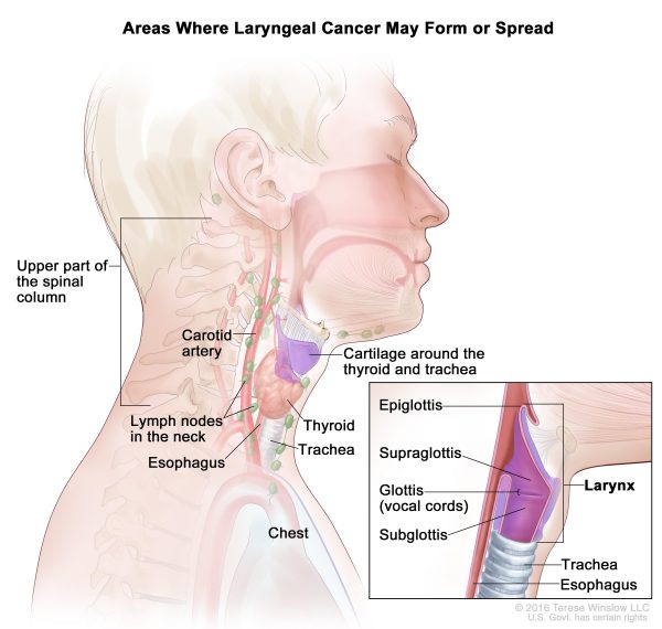 Ung thư thanh quản giai đoạn cuối có khả năng di căn đến nhiều vị trí