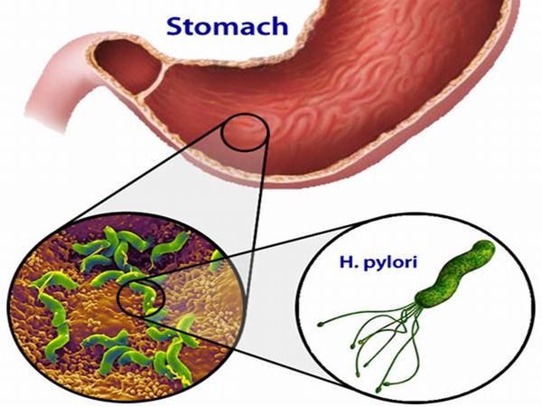 Vi khuẩn HP là một loại vi khuẩn phổ biến trong niêm mạc dạ dày, là nguyên nhân hàng đầu gây ra các bệnh về dạ dày