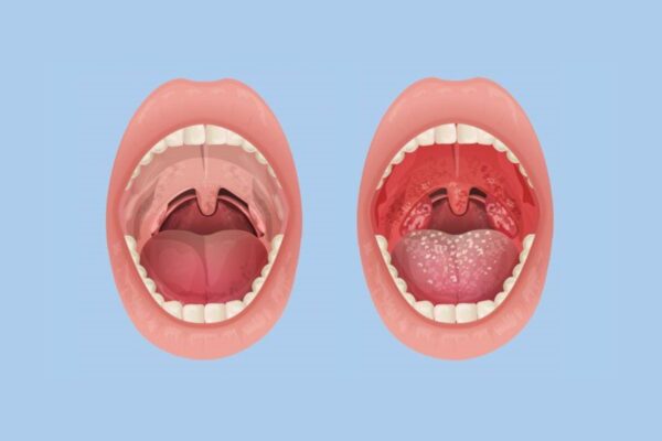 Viêm amidan có mủ là một bệnh lý vùng tai mũi họng nguy hiểm