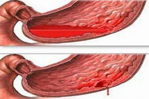 Xuất huyết tiêu hóa là một cấp cứu nội, ngoại khoa nguy hiểm