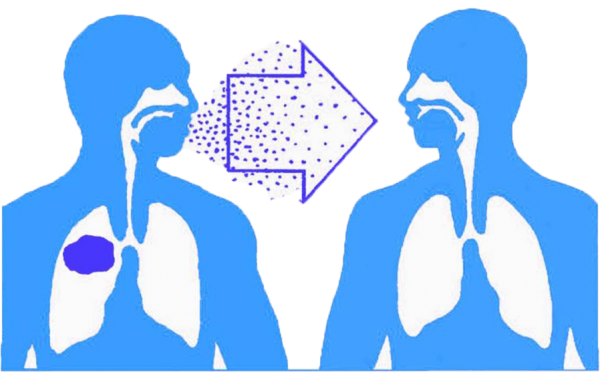 Bệnh lao phổi có lây không? Câu trả lời là lây nhiễm qua đường hô hấp