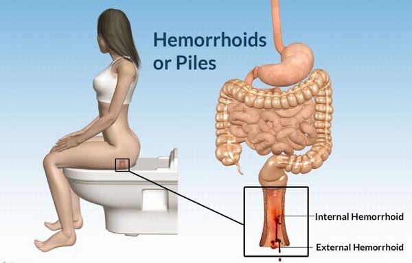 Bệnh trĩ cũng là một trong những bệnh lý ở hậu môn trực tràng thường gặp