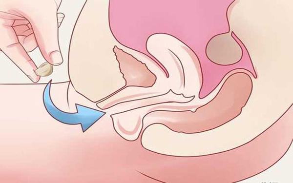 Đặt thuốc trong âm đạo là phương pháp thường được áp dụng ở giai đoạn viêm lộ tuyến nhẹ