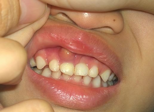 Viêm lợi cũng là một trong những nguyên nhân khiến bạn chảy máu chân răng