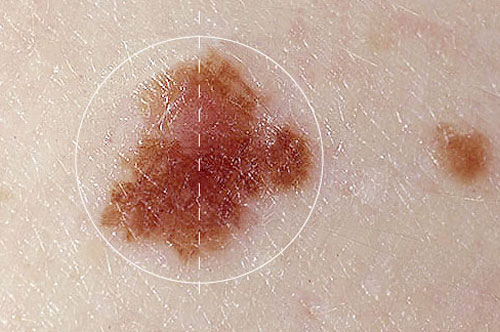 Nốt ruồi bất thường liên quan đến u sắc tố ác tính có thể là dấu hiệu cảnh báo ung thư da