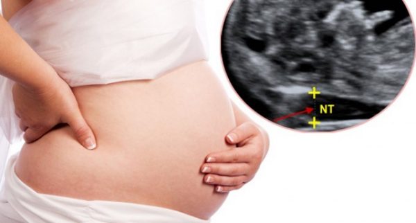 Bố hoặc mẹ làm việc, sinh sống trong môi trường hóa chất độc hại làm tăng nguy cơ mắc hội chứng down ở thai nhi.