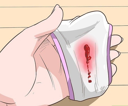 Chảy máu sau quan hệ bệnh viêm lộ tuyến cổ tử cung