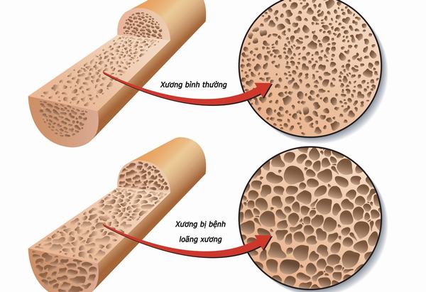 Chuyên gia cho rằng, những người không tổng hợp đủ canxi sẽ có phần trăm bị sỏi thận cao hơn những người có chế độ canxi cao.
