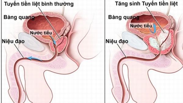 Tăng sản tuyến tiền liệt hay bệnh phì đại tuyến tiền liệt là một bệnh lý thường gặp ở nam giới.