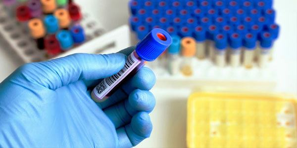 Xét nghiệm máu là một phương pháp giúp phát hiện sớm sự hiện diện của virus EBV trong cơ thể