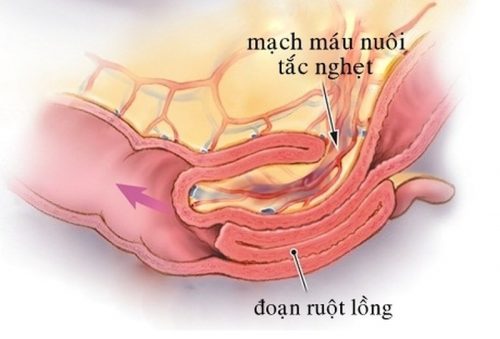 Lồng ruột là một trong những nguyên nhân phổ biến gây tắc ruột