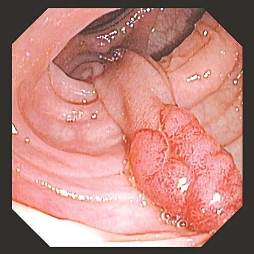 Polyp trực tràng là những khối u lồi vào trong lòng trực tràng.
