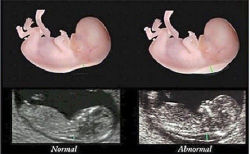 Tất cả thai nhi ddều có kết tụ chất dịch ở vùng cổ nhưng với trẻ bị Down, chất dịch này tăng đáng kể.