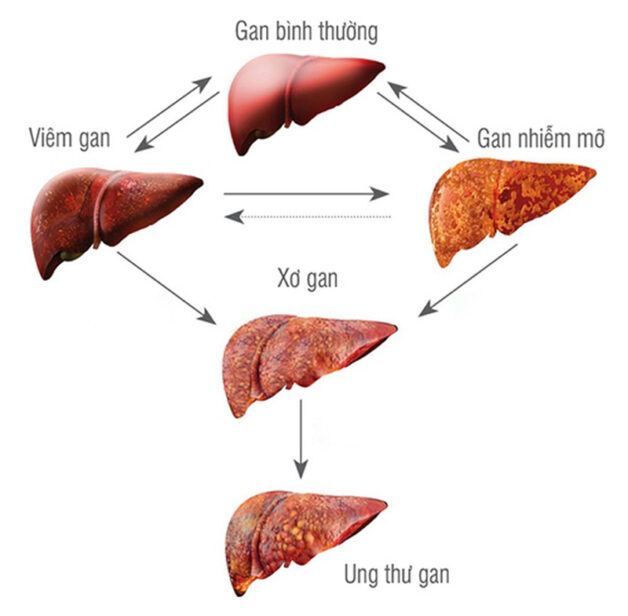 Các thông tin quan trọng về ung thư gan ở giai đoạn 2