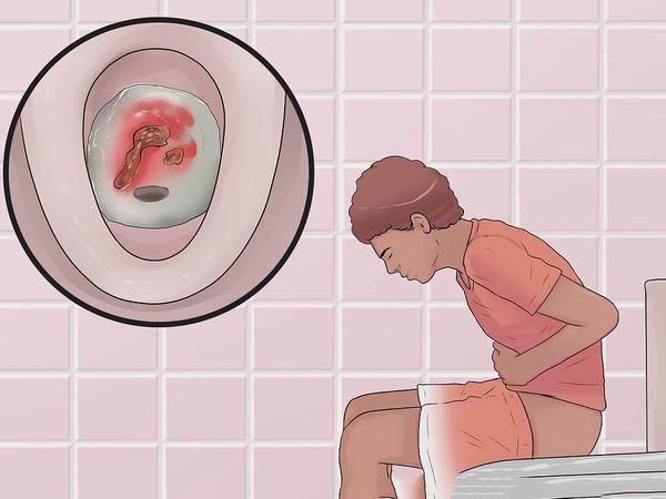 Rối loạn đại tiện, đi ngoài ra máu cũng là triệu chứng của bệnh viêm đại tràng cần đi khám ngay