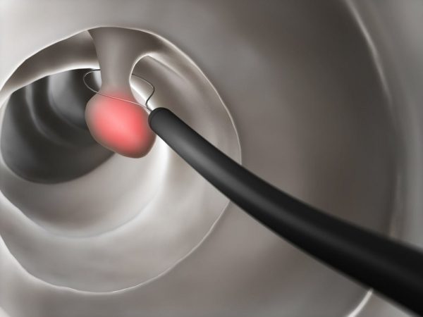 Polyp dạ dày là những khối u lồi có kích thước, hình dạng khác nhau (tròn hay elip), có cuống đôi khi được gọi là khối u