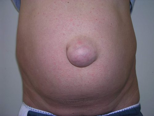 Thoát vị rốn thường xảy ra ở trẻ sơ sinh