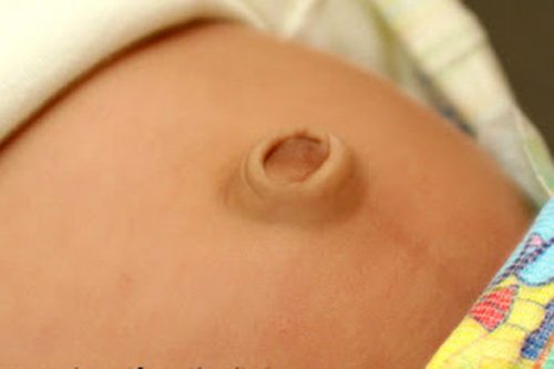 Để biết thêm thông tin chi tiết hoặc cần giải đáp thêm về triệu chứng thoát vị rốn, bạn đọc vui lòng liên hệ với Bệnh viện Đa khoa Quốc tế Thu Cúc  theo số điện thoại 024.383.55555 hoặc 1900 558892 hoặc hotline: 0936 388 288.