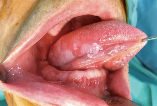 HÌNH ẢNH UNG THƯ LƯỠI GIAI ĐOẠN 2 VỚI KHỐI U LỚN HƠN NHƯNG CHƯA LAN RỘNG