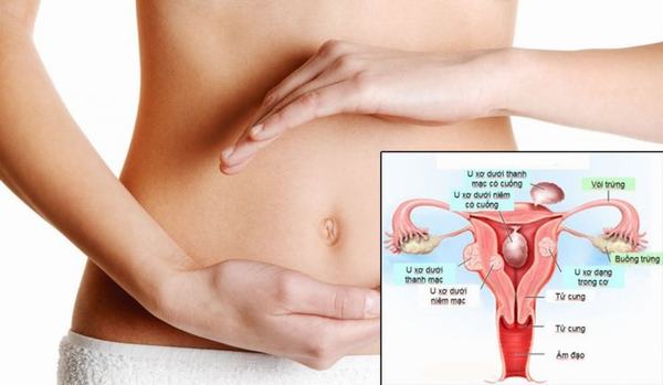 U xơ cổ tử cung là những khối tăng trưởng của mô ở cổ tử cung.