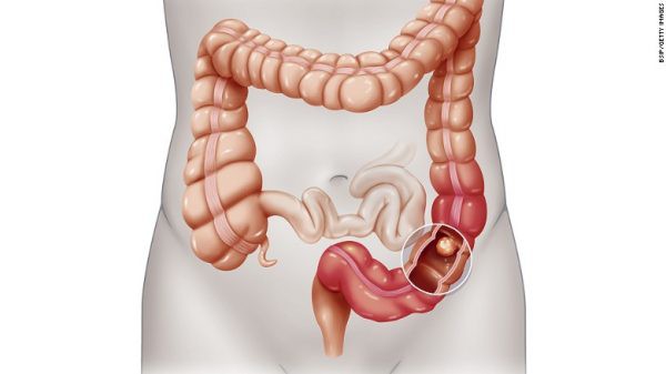 Ung thư đại tràng bắt nguồn từ các mô của đại tràng, phần dài nhất của ruột già