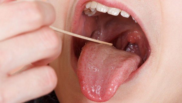 Ung thư lưỡi rất nguy hiểm, đặc biệt là khi không được phát hiện, điều trị tích cực sớm
