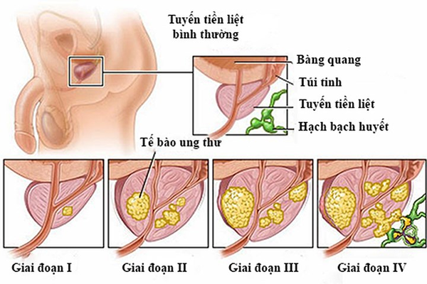 Ung thư tuyến tiền liệt giai đoạn III