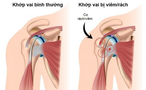 Viêm Cơ Nhị Đầu Vai triệu chứng thế nào và Có Nguy Hiểm Không? 1