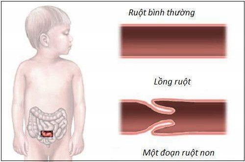 Chứng lồng ruột thường xảy ra ở trẻ em đặc biệt là trẻ dưới 24 tháng