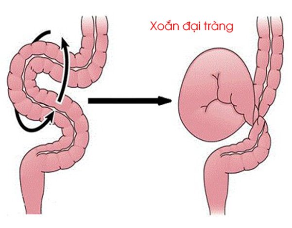 xoắn ruột là gì